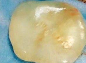 女婴带一块“玉”出生 医生：全世界极为罕见 一起来看看