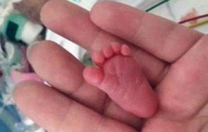 德国新生婴儿体重仅有0.4斤 脚掌比成人指甲还小